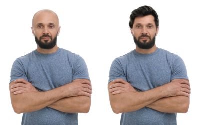 Baldness.,Man,Before,And,After,Wearing,Wig,Or,Hair,Treatment,